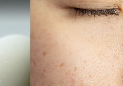 split image of lotion drops and a persons face with some acne marks