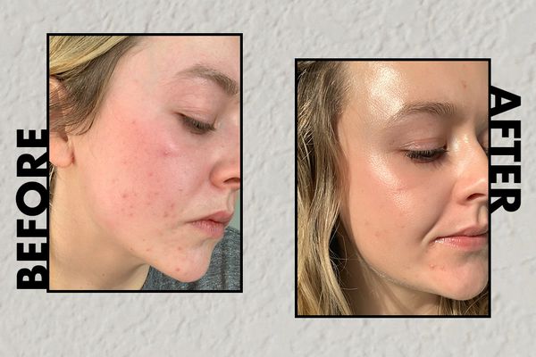 woman's azelaic acid before and after photo