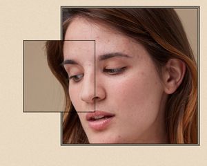 Up close of a woman with acne.