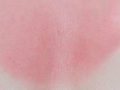 sunburn