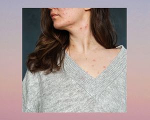 adult acne