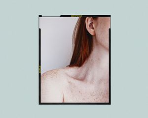 sun spots