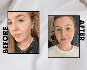 Holistic Acne Before / After